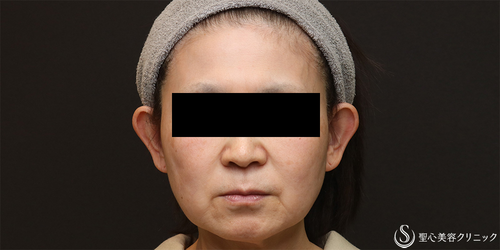 【50代女性・フェイスラインをスッキリ】フェイスリフト+脂肪吸引（頬）+リガメント(1ヶ月後) Before 