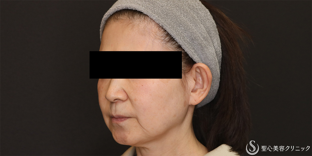 【50代女性・フェイスラインをスッキリ】フェイスリフト+脂肪吸引（頬）+リガメント(1ヶ月後) Before 