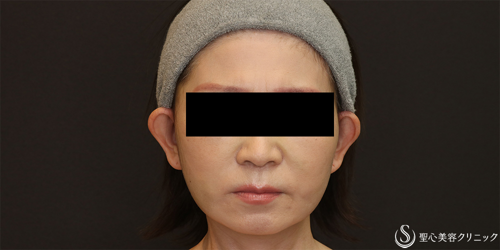 【50代女性・フェイスラインをスッキリ】フェイスリフト+脂肪吸引（頬）+リガメント(1ヶ月後) After 