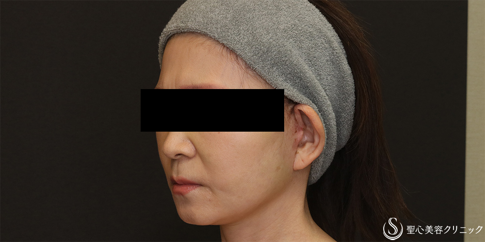 【50代女性・フェイスラインをスッキリ】フェイスリフト+脂肪吸引（頬）+リガメント(1ヶ月後) After 