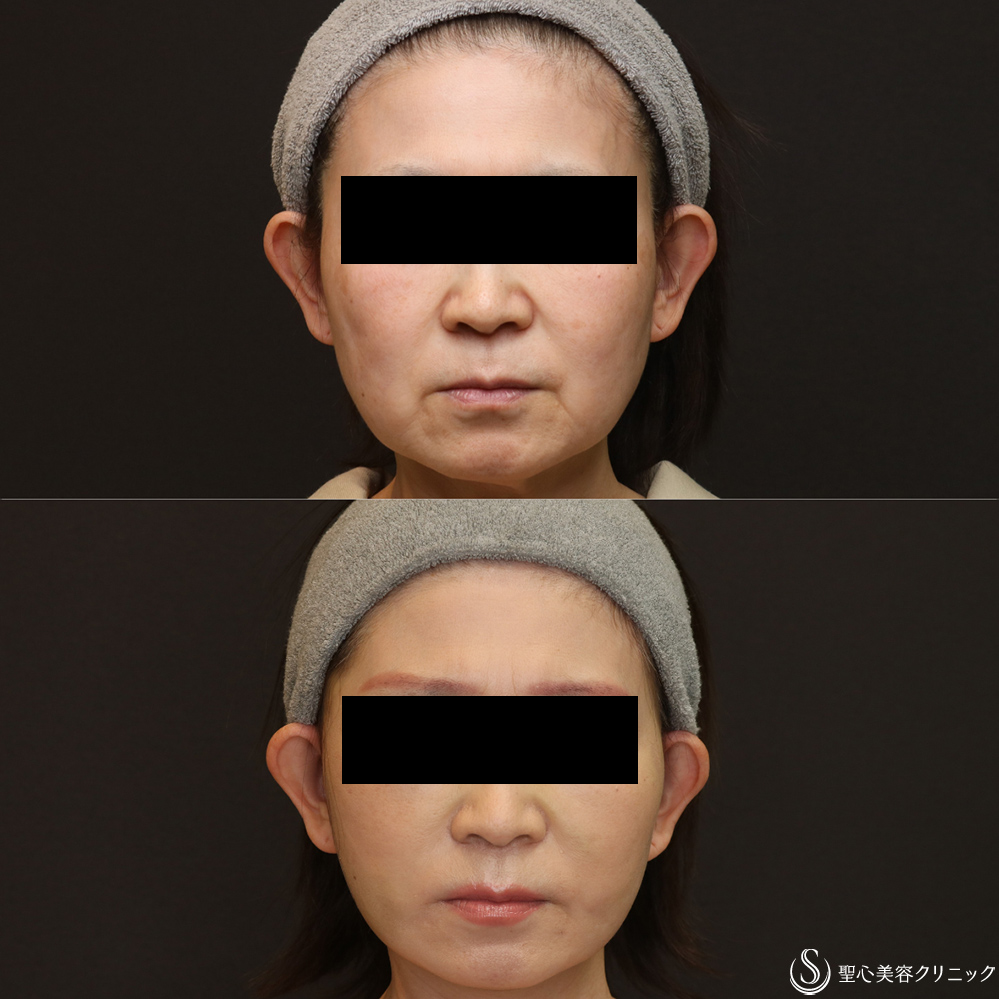 【50代女性・フェイスラインをスッキリ】フェイスリフト+脂肪吸引（頬）+リガメント(1ヶ月後) After 