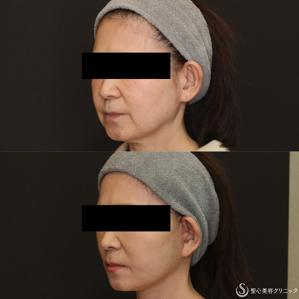 【50代女性・フェイスラインをスッキリ】フェイスリフト+脂肪吸引（頬）+リガメント(1ヶ月後) After 