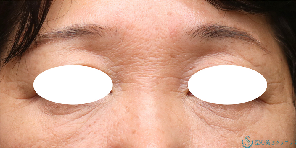 【60代女性・自然な若返り】プレミアムPRP皮膚再生療法(目の下・眉間)(3か月後) After 