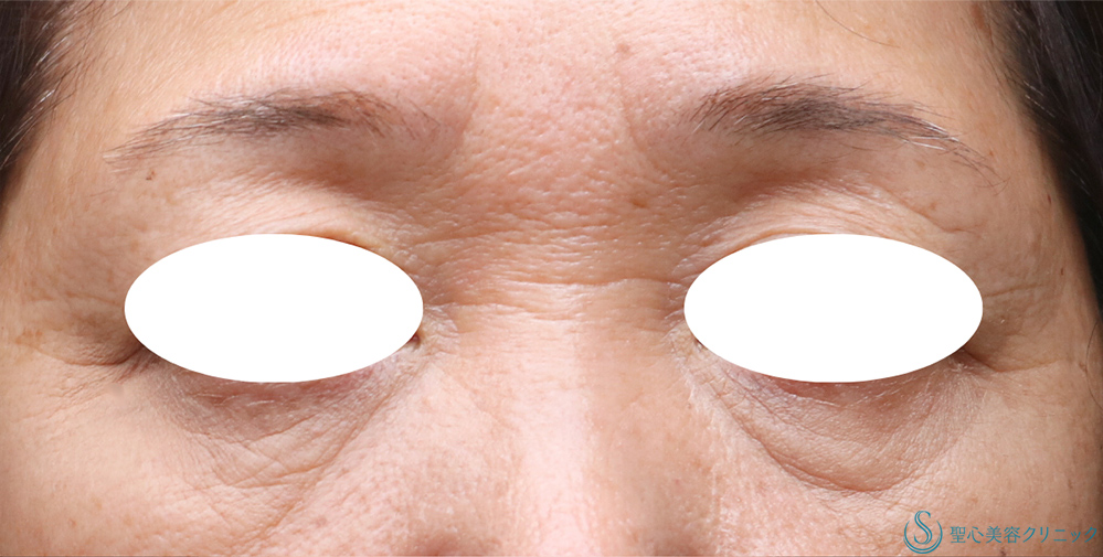 【60代女性・自然な若返り】プレミアムPRP皮膚再生療法(目の下・眉間)(3か月後) Before 