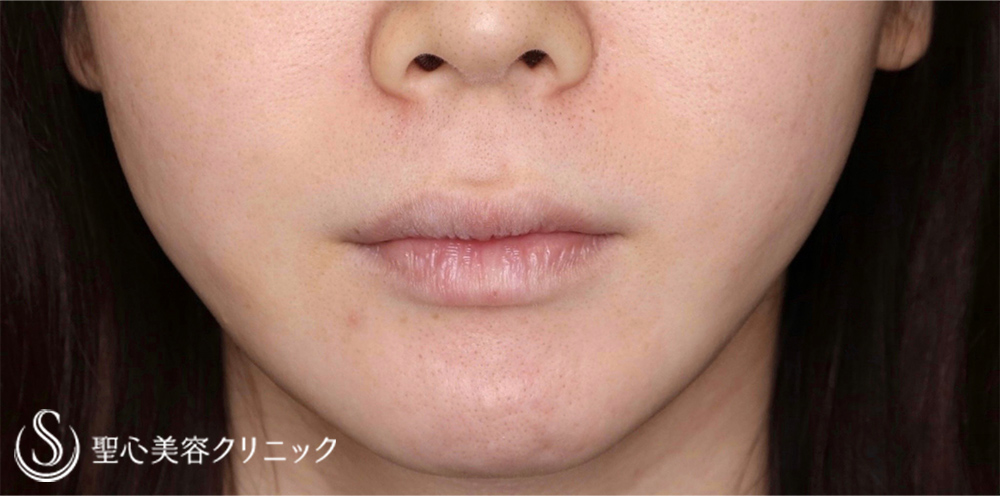【20代女性・口元のバランスを可愛く整えたい！！】プレミアムリップリフト（プレミアム人中短縮術）＋プレミアム口角挙上術（術後1ヶ月） Before 