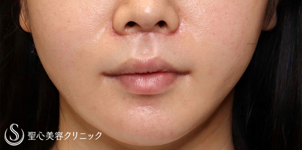 【20代女性・口元のバランスを可愛く整えたい！！】プレミアムリップリフト（プレミアム人中短縮術）＋プレミアム口角挙上術（術後1ヶ月） After 
