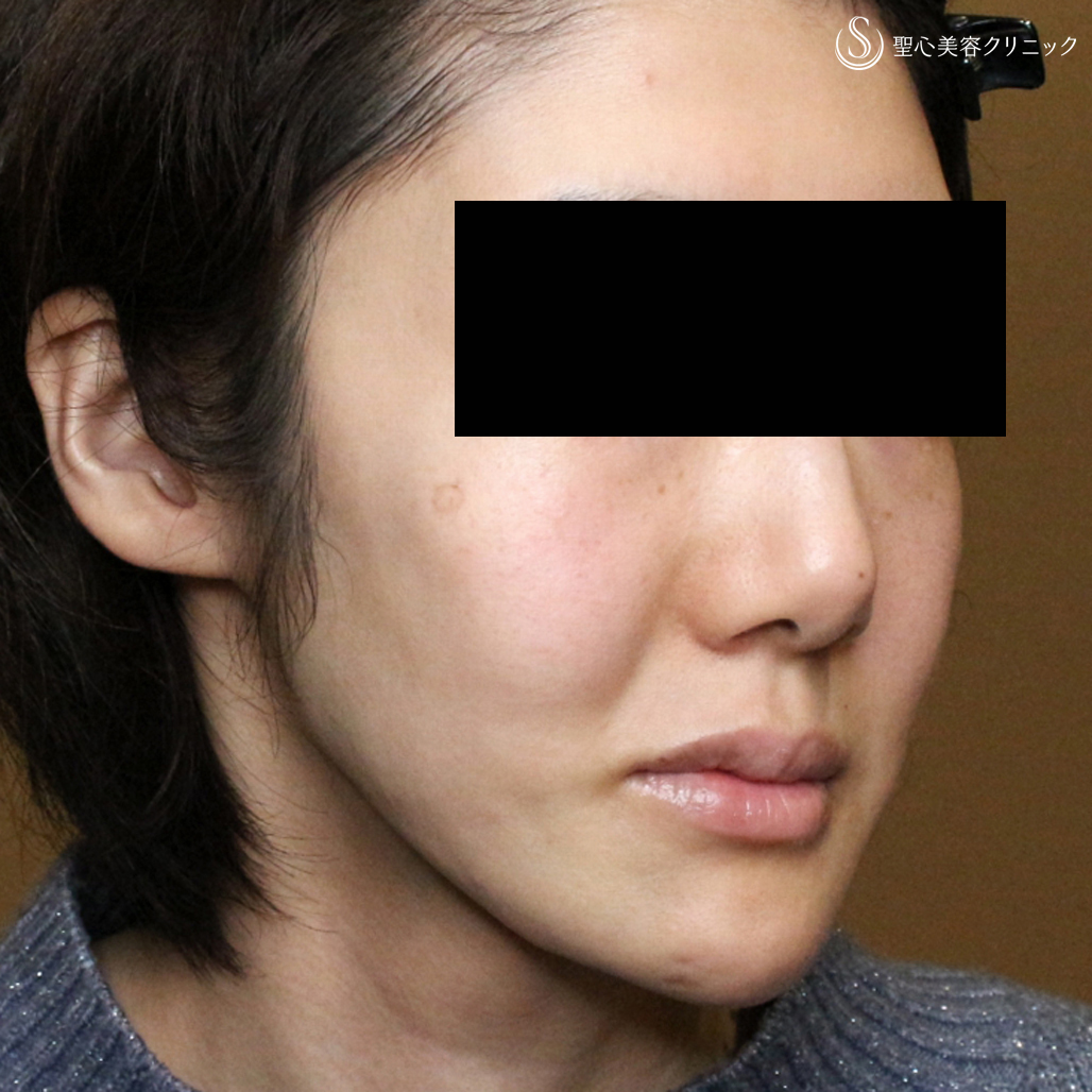 【30代女性・進行性顔面片側萎縮症（ロンバーグ病）】プレミアムPRP皮膚再生療法（直後〜1年4ヶ月後） After 
