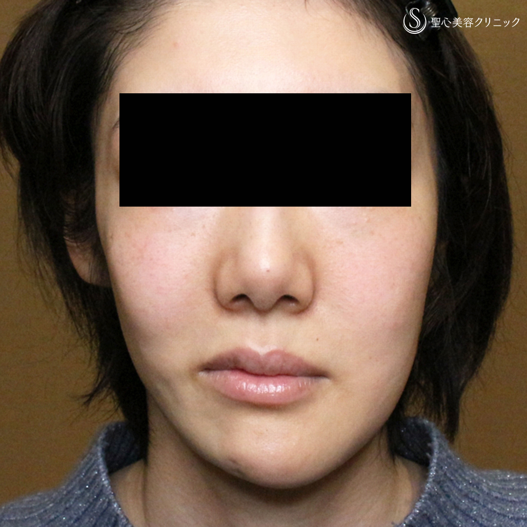 【30代女性・進行性顔面片側萎縮症（ロンバーグ病）】プレミアムPRP皮膚再生療法（直後〜1年4ヶ月後） After 