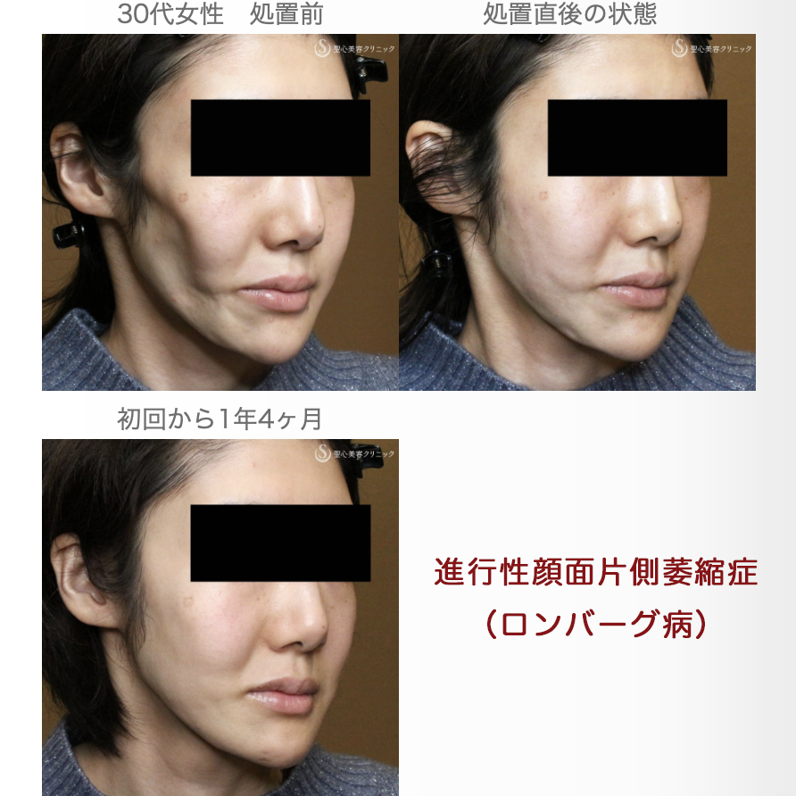 【30代女性・進行性顔面片側萎縮症（ロンバーグ病）】プレミアムPRP皮膚再生療法（直後〜1年4ヶ月後） After 