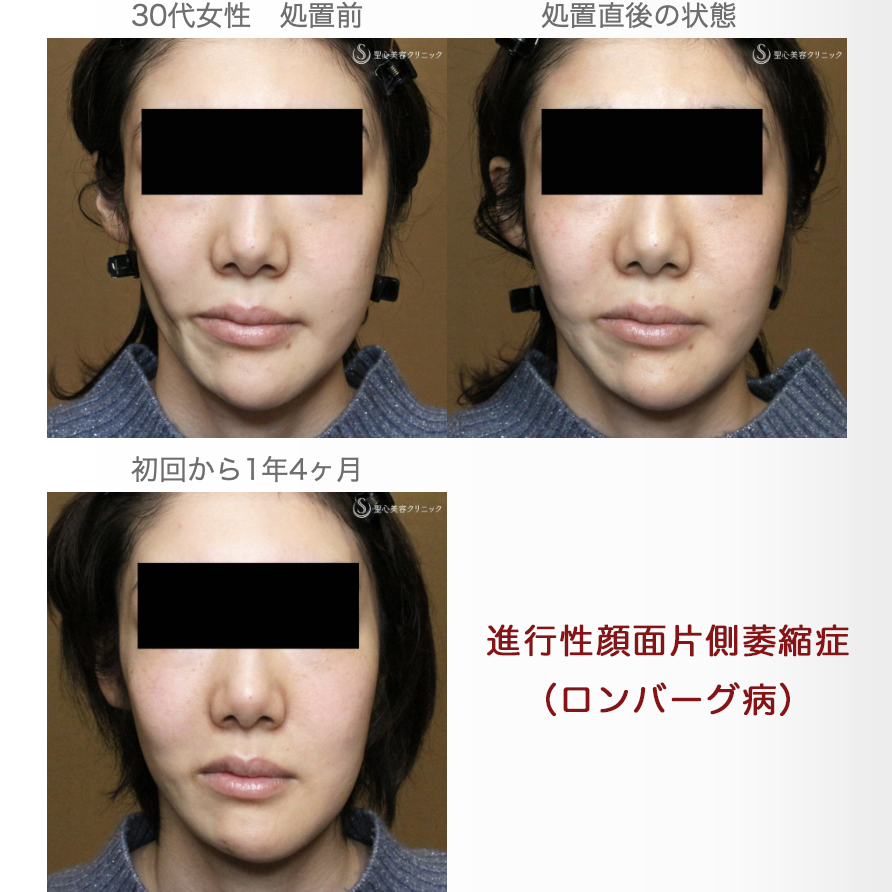 【30代女性・進行性顔面片側萎縮症（ロンバーグ病）】プレミアムPRP皮膚再生療法（直後〜1年4ヶ月後） After 