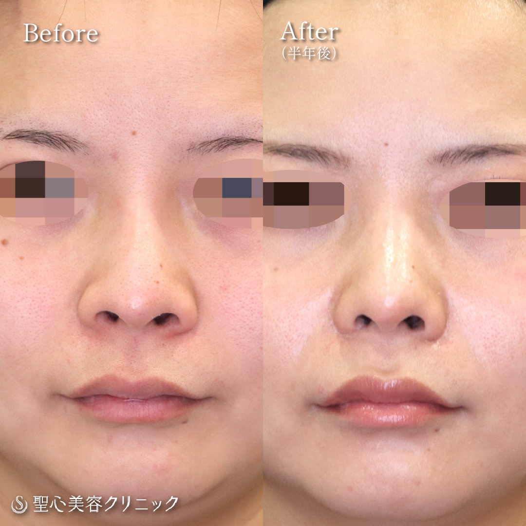 【20代女性・鼻の凹みの整復】オステオポールとプロテーゼ除去など修正術（半年後） Before 