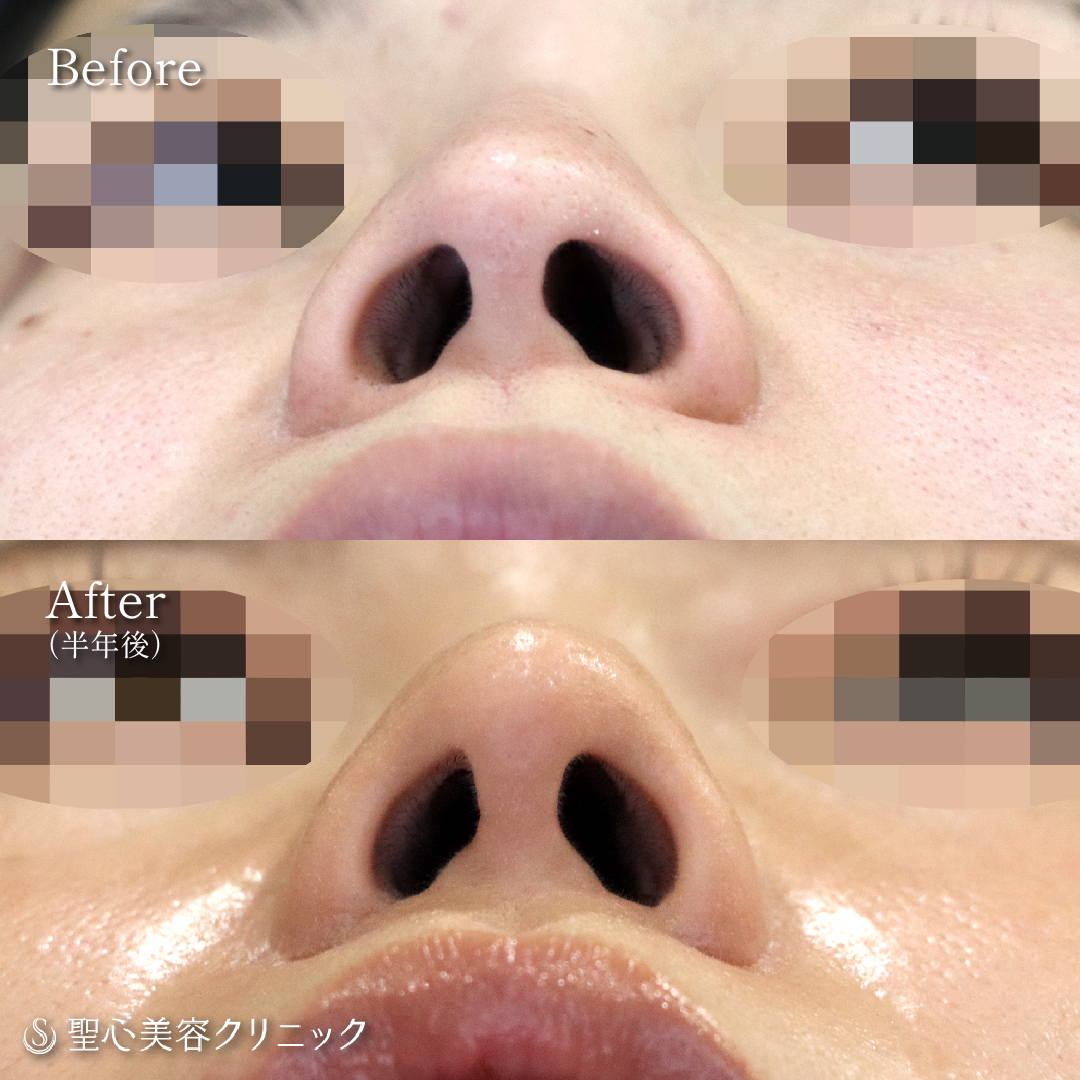 【20代女性・鼻の凹みの整復】オステオポールとプロテーゼ除去など修正術（半年後） After 