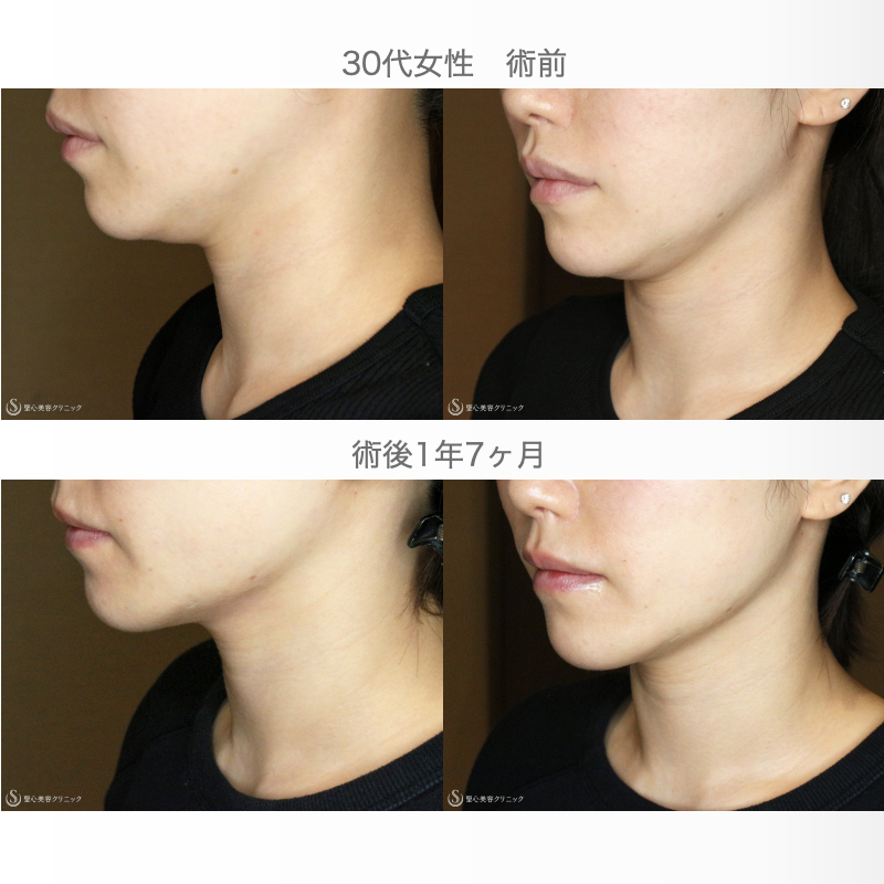 【30代女性・二重アゴ解消】脂肪吸引注射「あご下」（直後〜1年7ヶ月後） After 