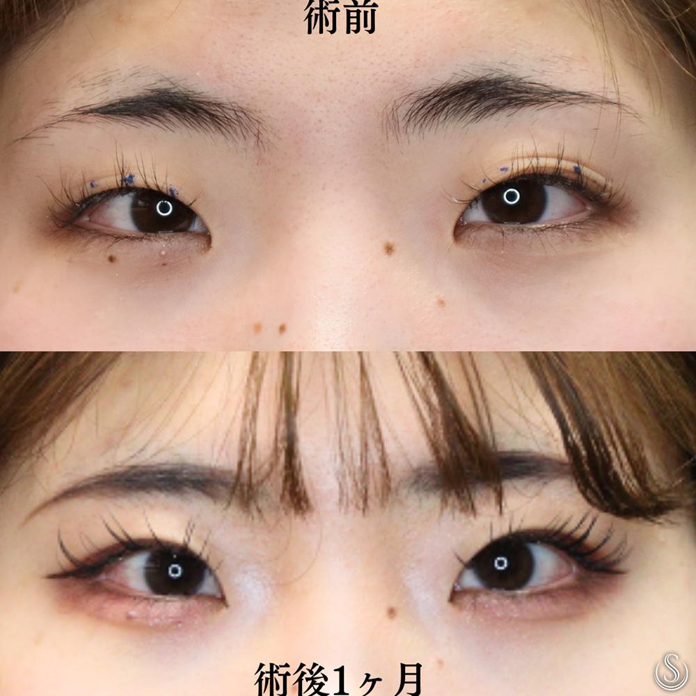 【20代女性・二重埋没法で綺麗な目元へ】二重術（埋没法）：マイクロメソッド+α（1ヶ月後） Before 