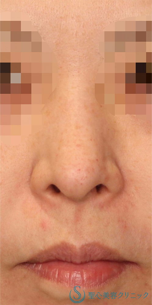 【30代女性・鼻の穴を目立ちにくくしたい！！】鼻孔縁下降術（術後1ヶ月） Before 