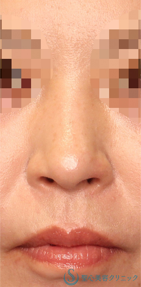 【30代女性・鼻の穴を目立ちにくくしたい！！】鼻孔縁下降術（術後1ヶ月） After 