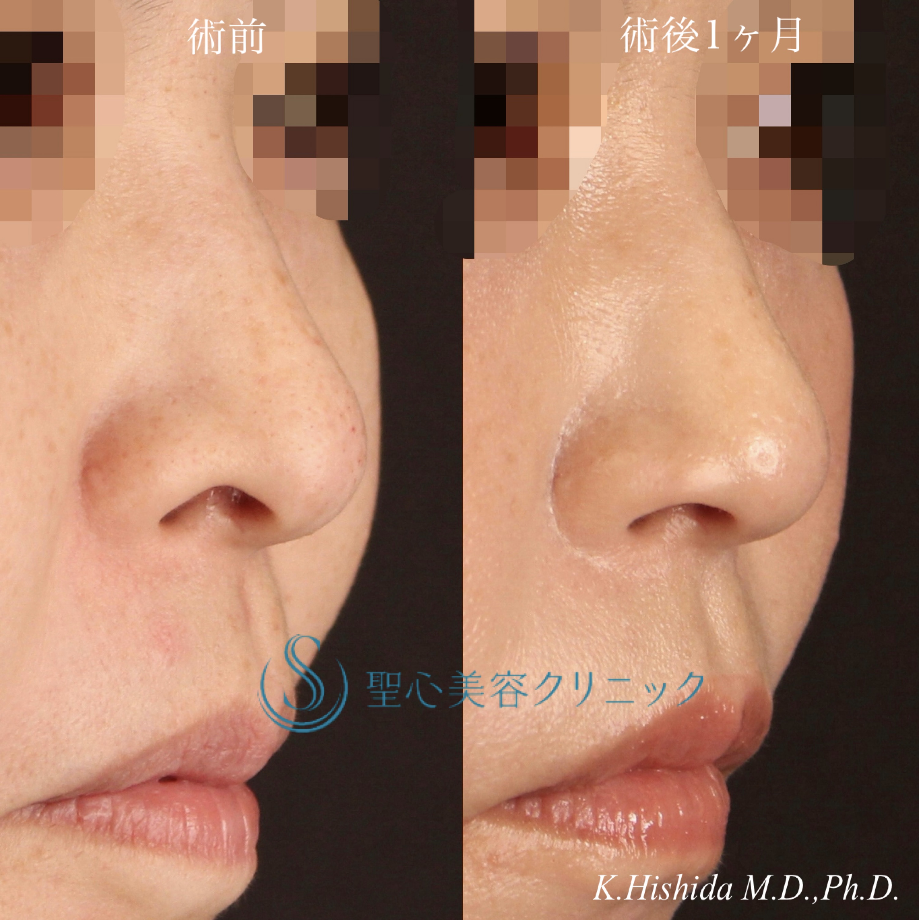 【30代女性・鼻の穴を目立ちにくくしたい！！】鼻孔縁下降術（術後1ヶ月） After 