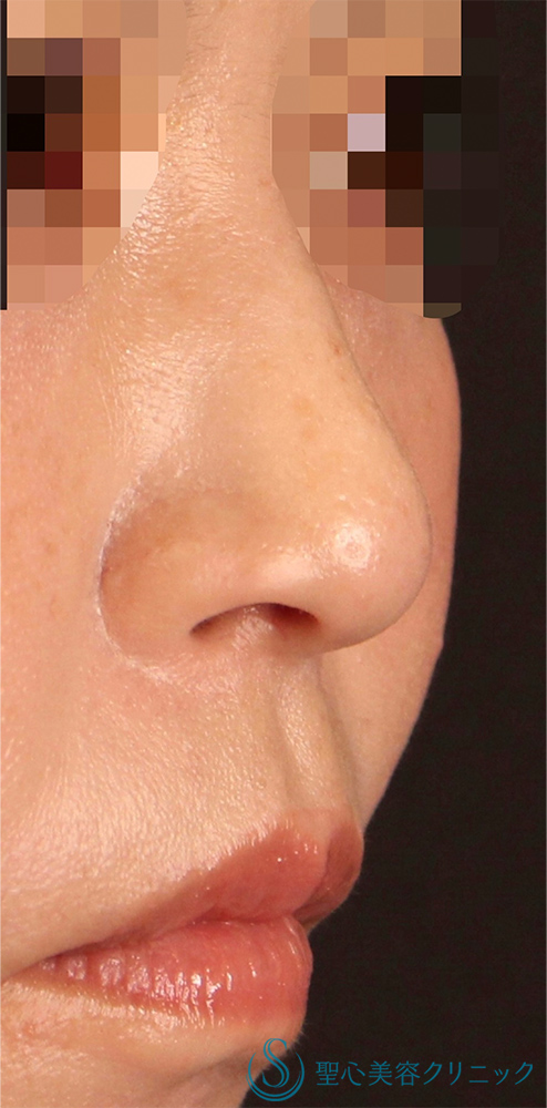 【30代女性・鼻の穴を目立ちにくくしたい！！】鼻孔縁下降術（術後1ヶ月） After 