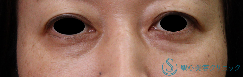 【40代女性・目の下のくま】プレミアムPRP皮膚再生療法（7ヶ月後） Before 