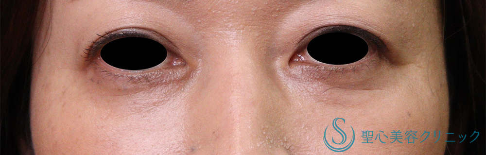 【40代女性・目の下のくま】プレミアムPRP皮膚再生療法（7ヶ月後） After 