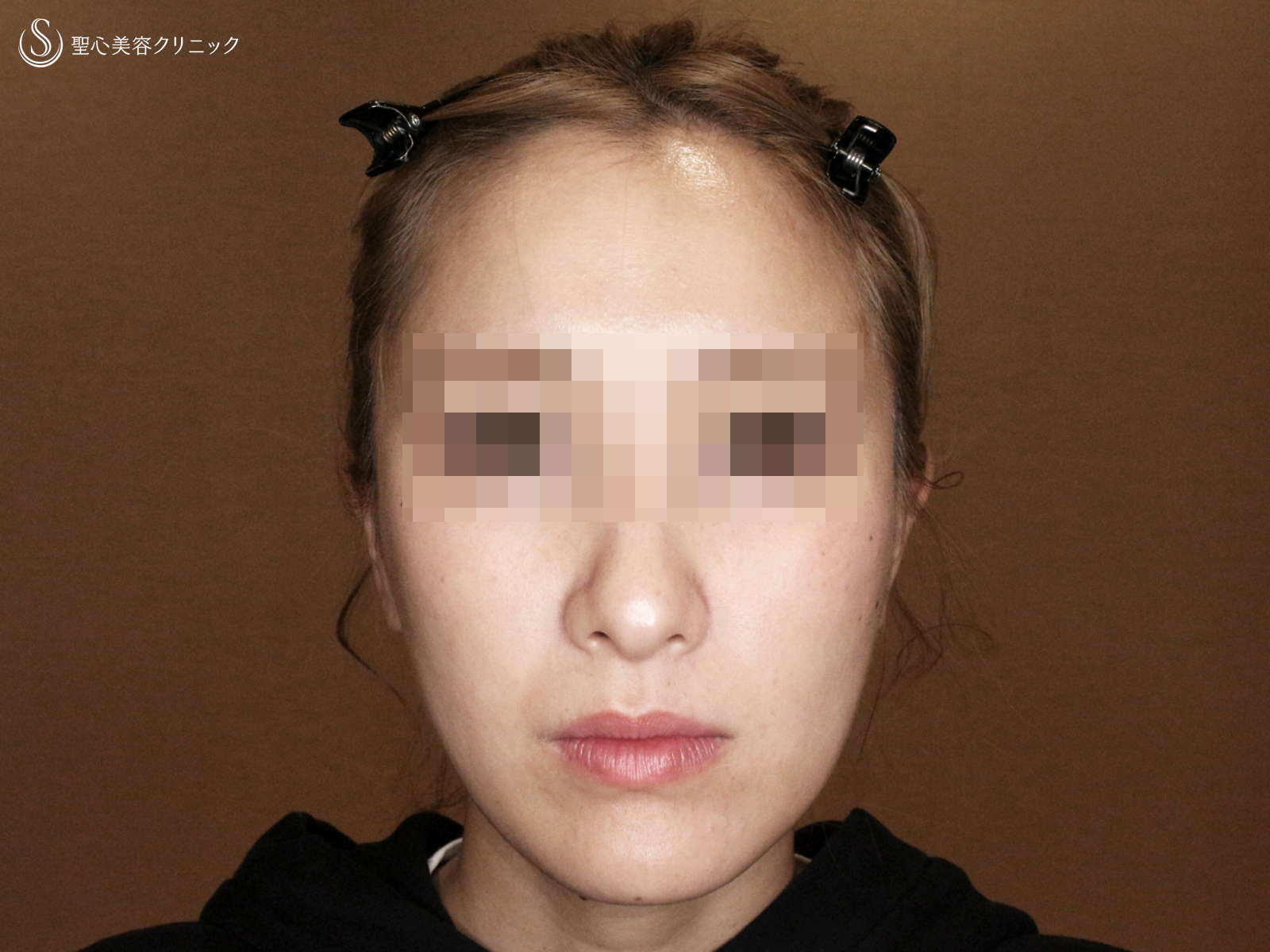 【20代女性・劇的な変化】エラボトックス（3回処置→7ヶ月後） After 