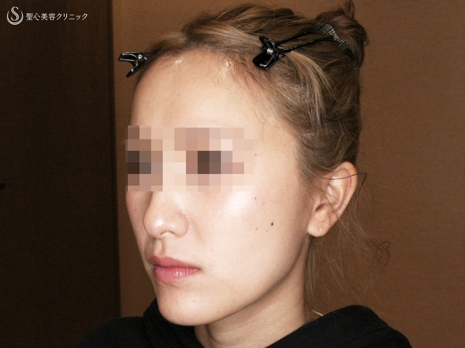 【20代女性・劇的な変化】エラボトックス（3回処置→7ヶ月後） After 