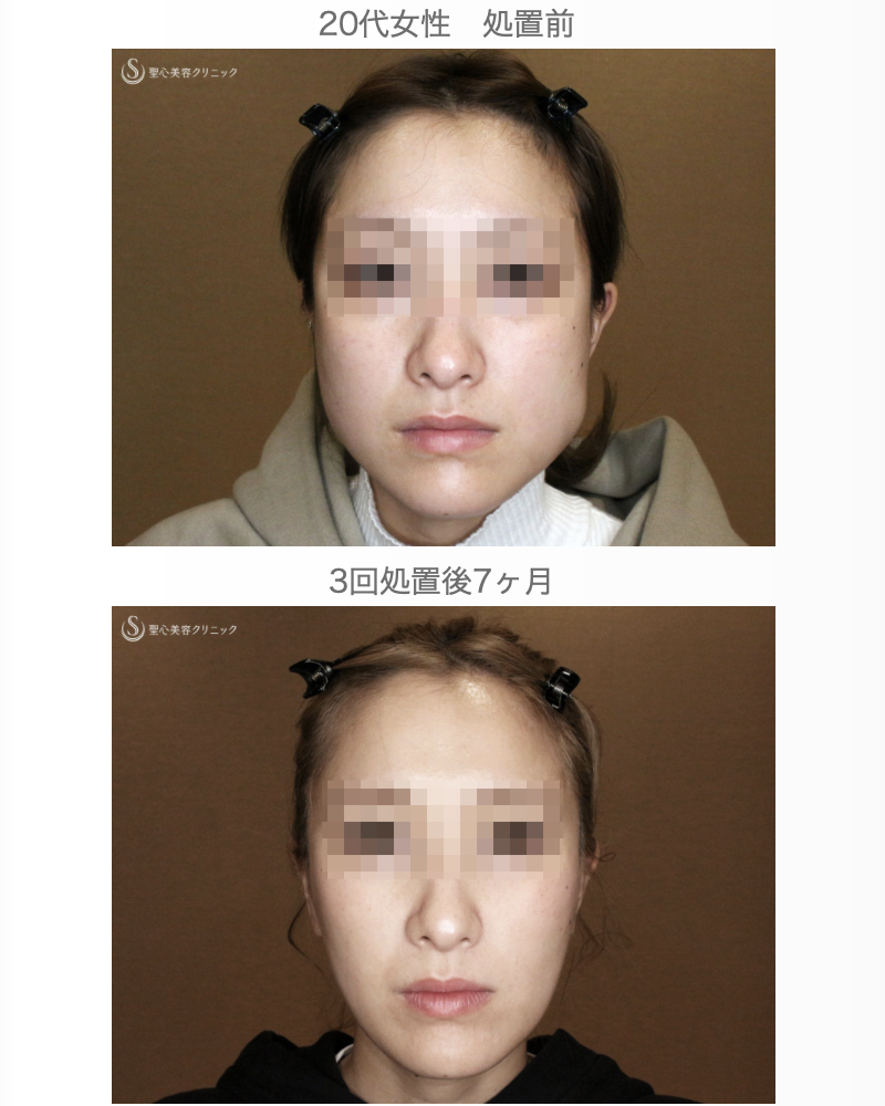 【20代女性・劇的な変化】エラボトックス（3回処置→7ヶ月後） After 