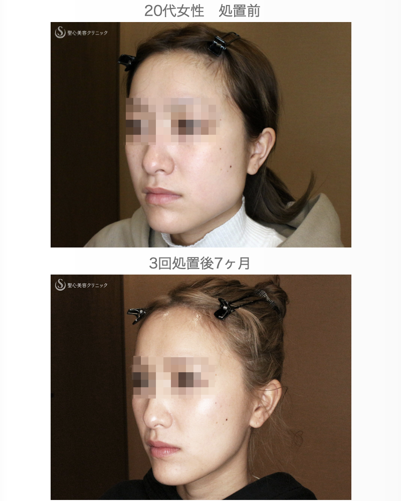 【20代女性・劇的な変化】エラボトックス（3回処置→7ヶ月後） After 