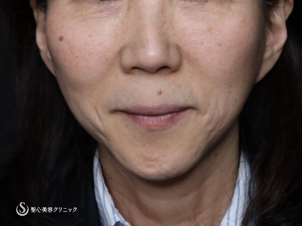 【60代女性・口元のたるみが目立たなくなりました】広範囲の切開リフト（プレミアムミニリフト＋ネックリフト）+リガメント処置+頬アゴ下脂肪吸引注射（半年後） Before 