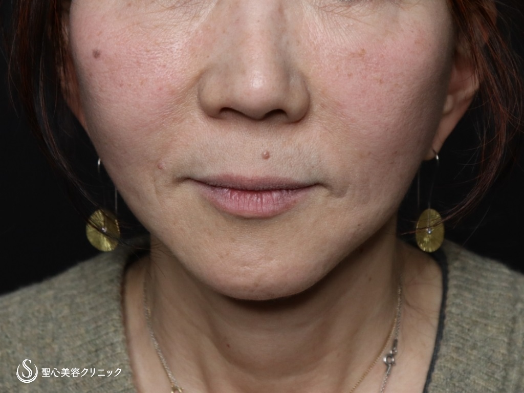 【60代女性・口元のたるみが目立たなくなりました】広範囲の切開リフト（プレミアムミニリフト＋ネックリフト）+リガメント処置+頬アゴ下脂肪吸引注射（半年後） After 