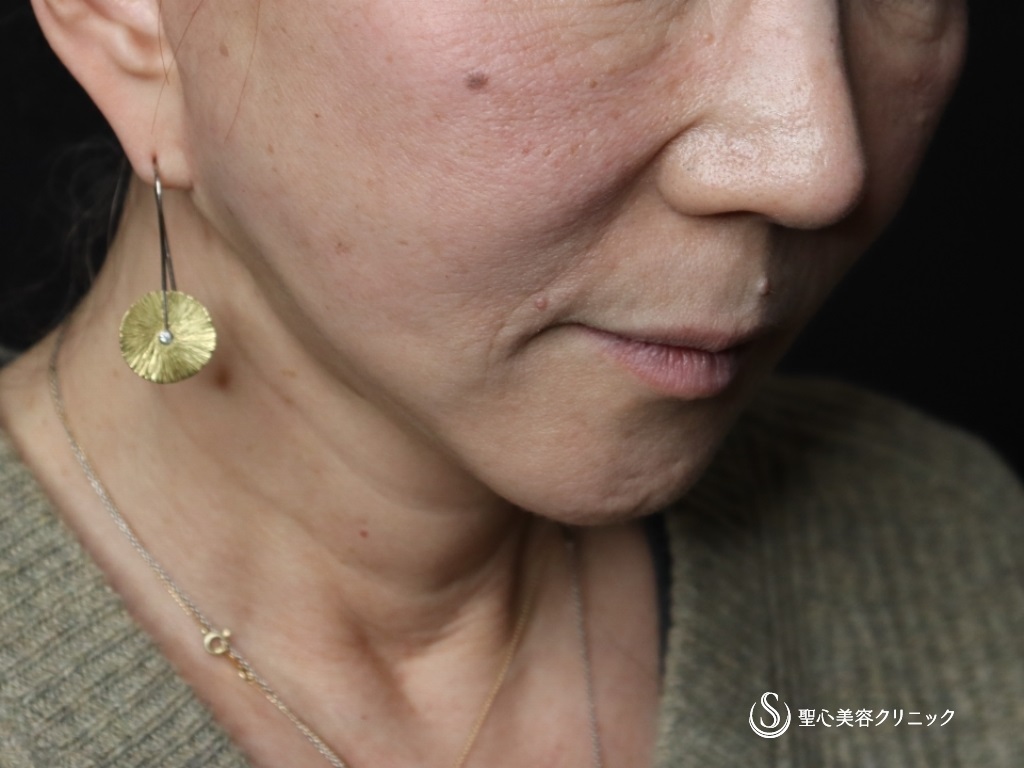 【60代女性・口元のたるみが目立たなくなりました】広範囲の切開リフト（プレミアムミニリフト＋ネックリフト）+リガメント処置+頬アゴ下脂肪吸引注射（半年後） After 