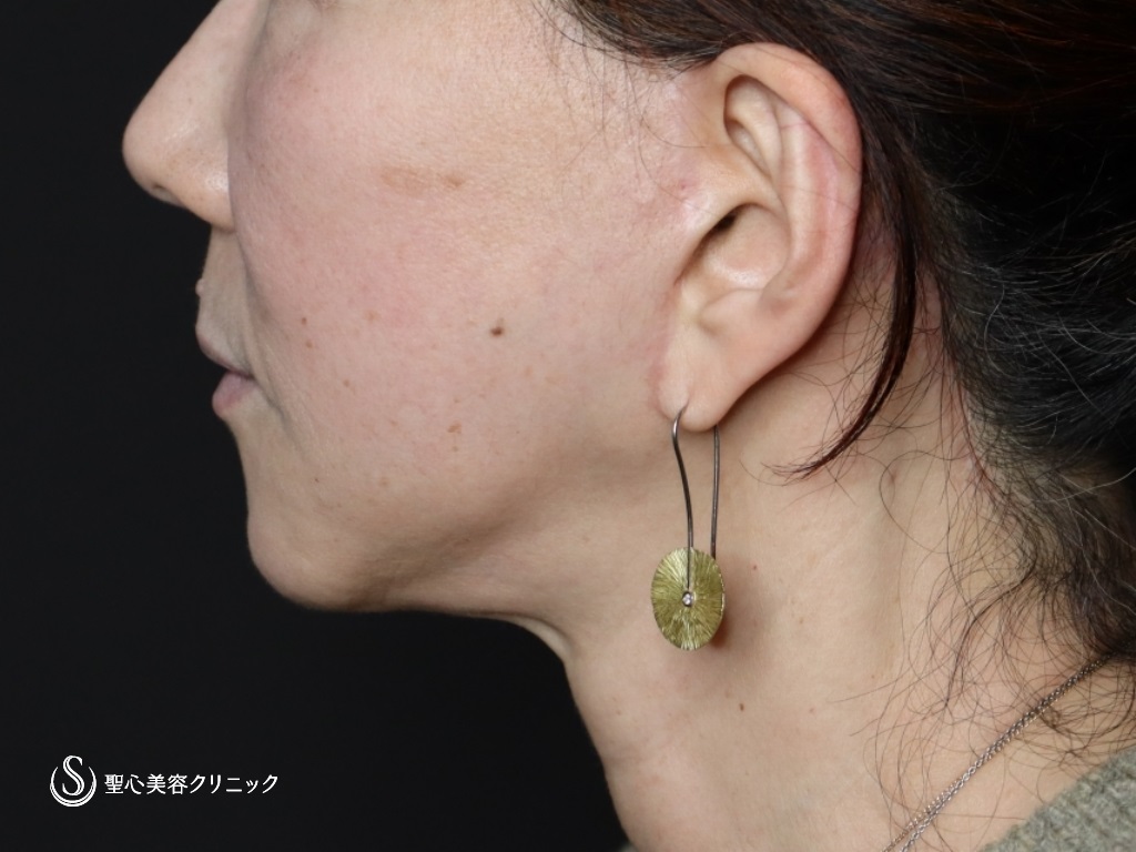 【60代女性・口元のたるみが目立たなくなりました】広範囲の切開リフト（プレミアムミニリフト＋ネックリフト）+リガメント処置+頬アゴ下脂肪吸引注射（半年後） After 