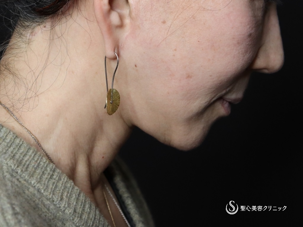 【60代女性・口元のたるみが目立たなくなりました】広範囲の切開リフト（プレミアムミニリフト＋ネックリフト）+リガメント処置+頬アゴ下脂肪吸引注射（半年後） After 