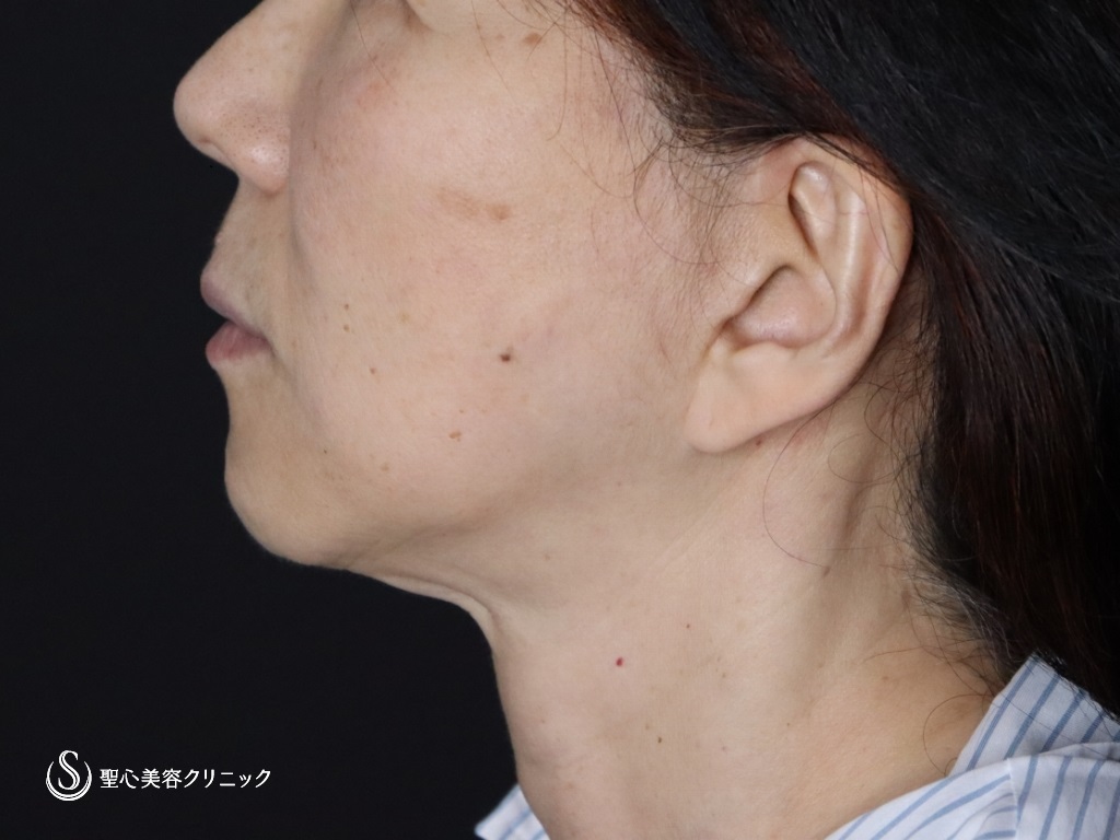 【60代女性・口元のたるみが目立たなくなりました】広範囲の切開リフト（プレミアムミニリフト＋ネックリフト）+リガメント処置+頬アゴ下脂肪吸引注射（半年後） Before 