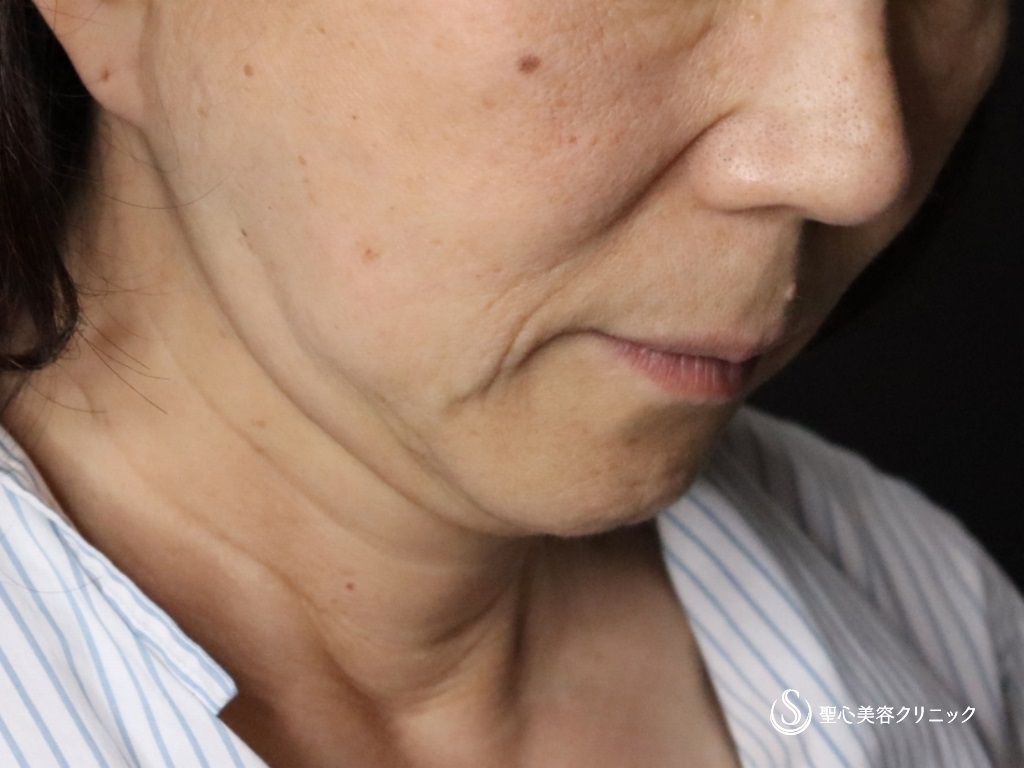 【60代女性・口元のたるみが目立たなくなりました】広範囲の切開リフト（プレミアムミニリフト＋ネックリフト）+リガメント処置+頬アゴ下脂肪吸引注射（半年後） Before 