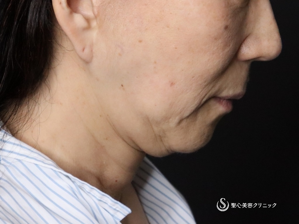 【60代女性・口元のたるみが目立たなくなりました】広範囲の切開リフト（プレミアムミニリフト＋ネックリフト）+リガメント処置+頬アゴ下脂肪吸引注射（半年後） Before 