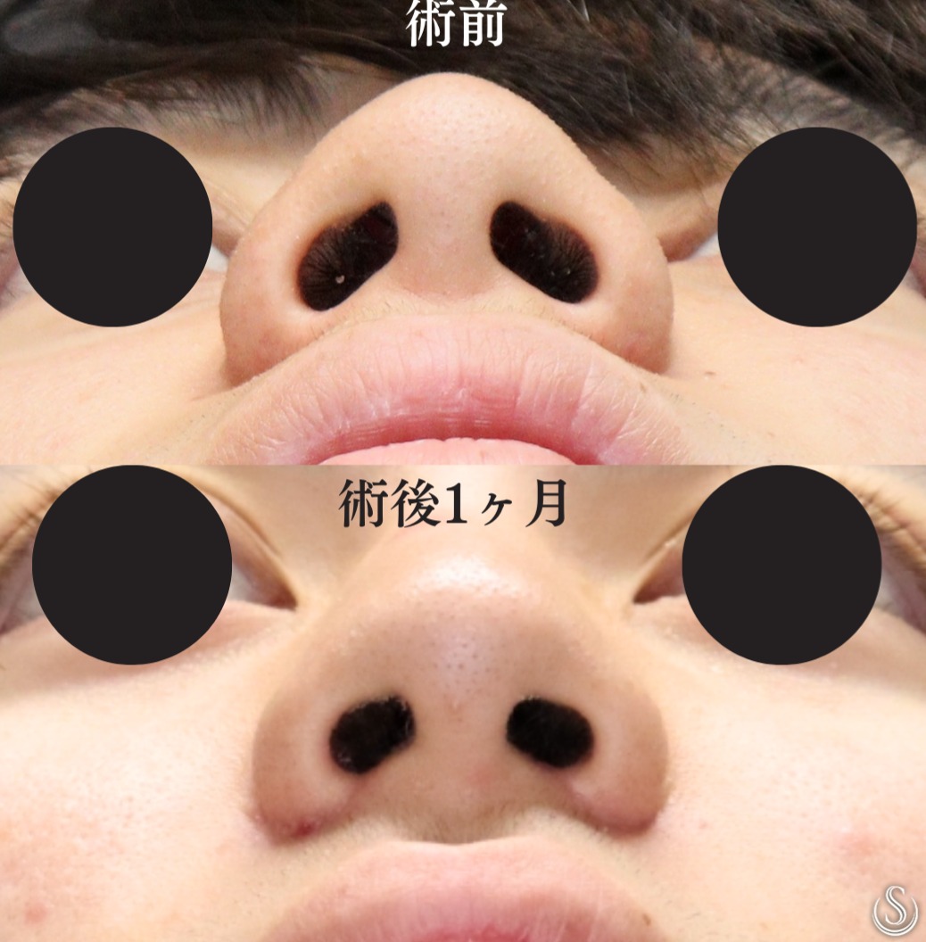 【20代男性・スッキリとした小鼻へ】小鼻縮小術（内側法＋外側法）（術後1ヶ月） After 