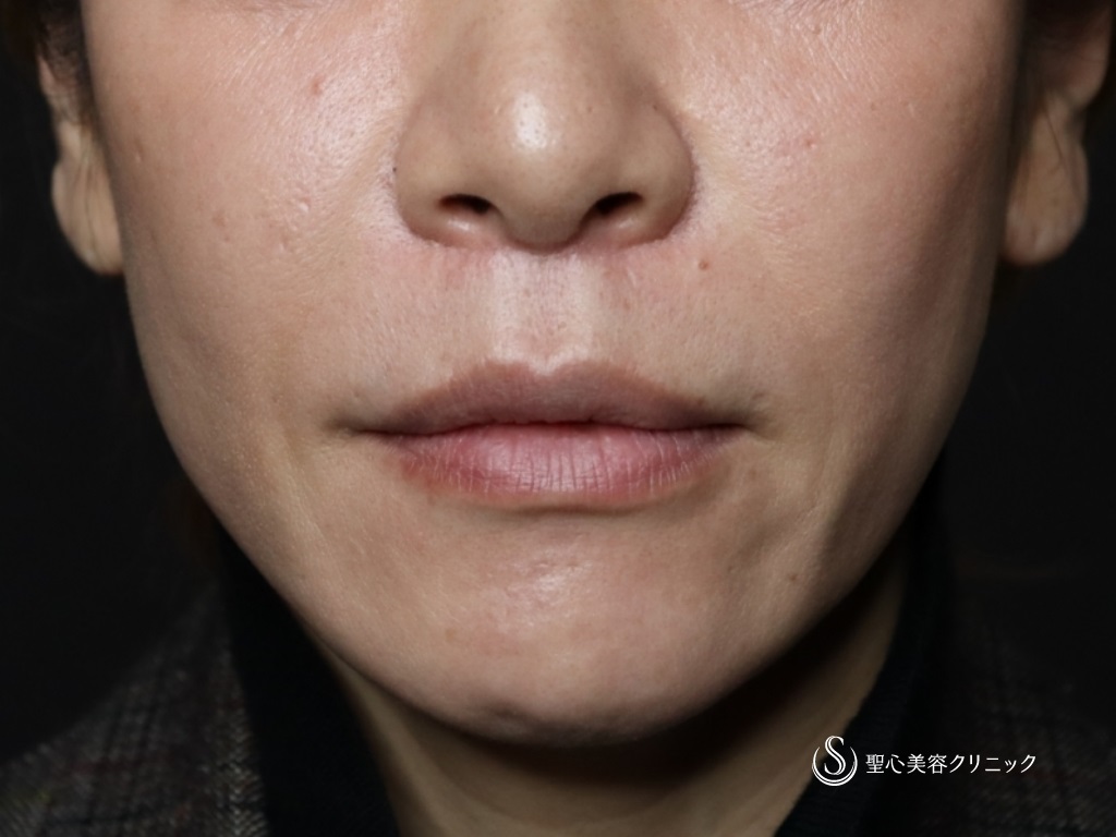 【40代女性・人中を短くしたい！】リップリフト（人中短縮術）（術後3ヶ月） After 