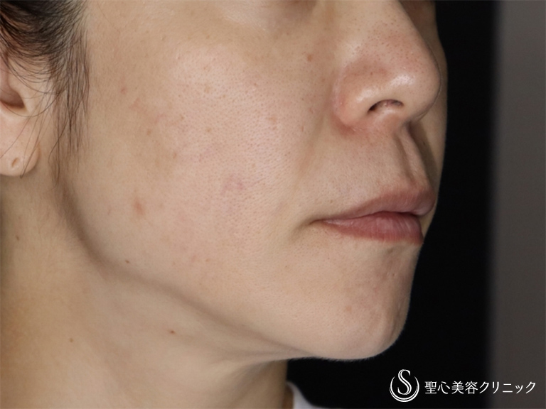 【40代女性・人中を短くしたい！】リップリフト（人中短縮術）（術後3ヶ月） Before 