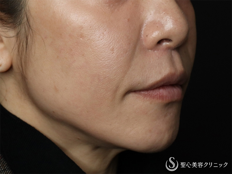 【40代女性・人中を短くしたい！】リップリフト（人中短縮術）（術後3ヶ月） After 