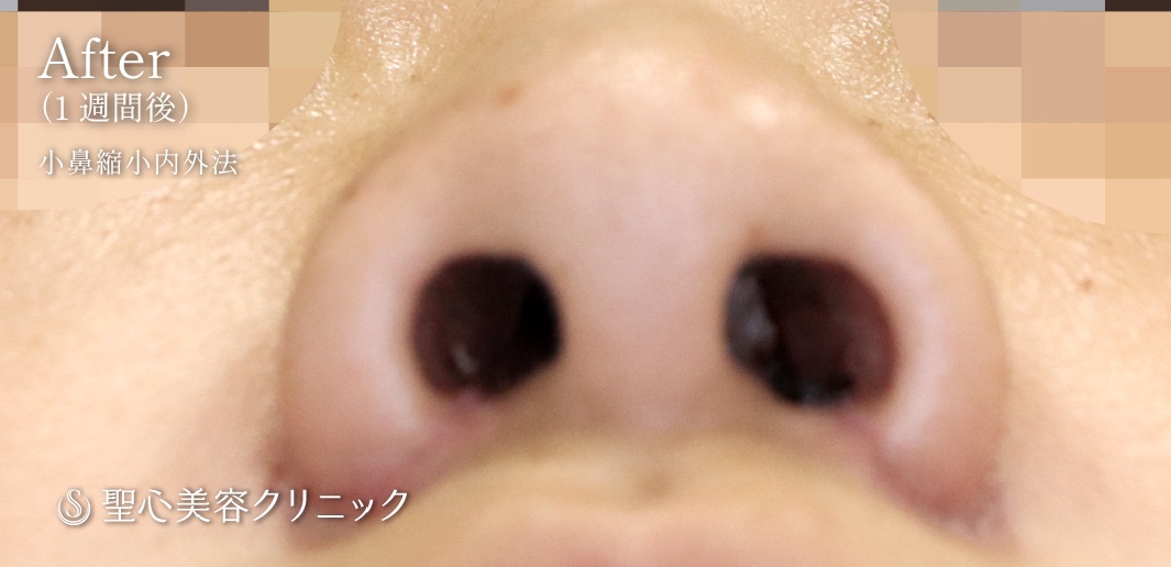 【30代女性・鼻の穴が小さくなりました】小鼻縮小術（内側法＋外側法）（術後1週間） After 