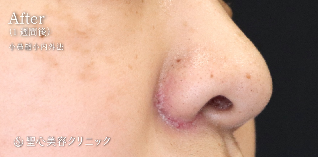 【30代女性・鼻の穴が小さくなりました】小鼻縮小術（内側法＋外側法）（術後1週間） After 