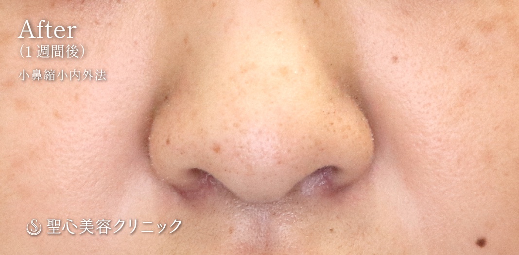 【30代女性・鼻の穴が小さくなりました】小鼻縮小術（内側法＋外側法）（術後1週間） After 