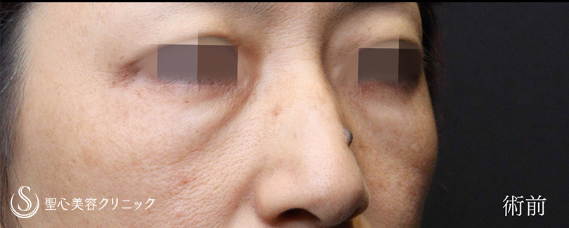 【50代女性・ハムラ法で目の下のクマをスッキリ】下眼瞼切開術/下眼瞼除皺術/ハムラ法（術後1ヶ月） Before 