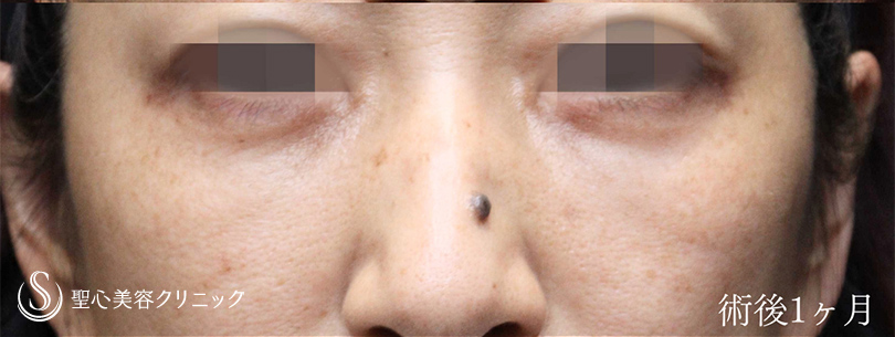 【50代女性・ハムラ法で目の下のクマをスッキリ】下眼瞼切開術/下眼瞼除皺術/ハムラ法（術後1ヶ月） After 