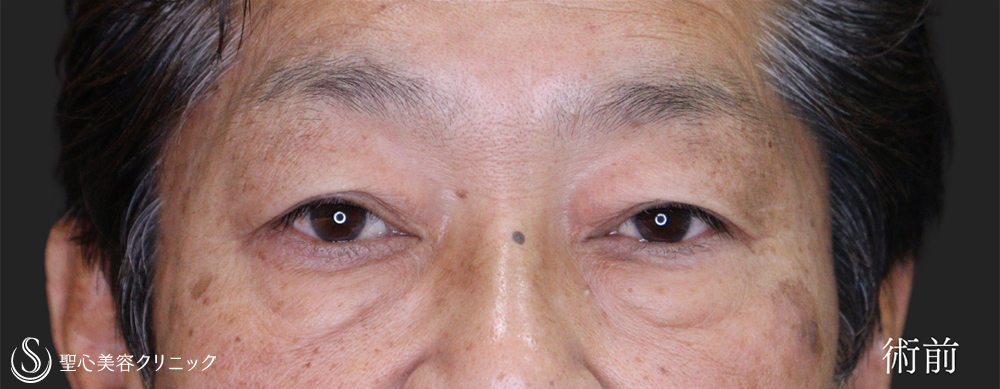 【60代男性・目の上下をスッキリ】下眼瞼切開術/下眼瞼除皺術/ハムラ法＋眉下切開法（眉下リフト）（術後1ヶ月） Before 
