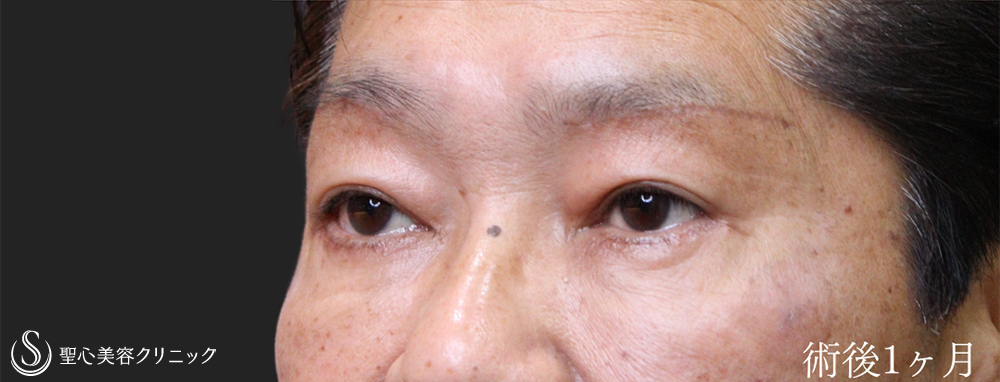 【60代男性・目の上下をスッキリ】下眼瞼切開術/下眼瞼除皺術/ハムラ法＋眉下切開法（眉下リフト）（術後1ヶ月） After 