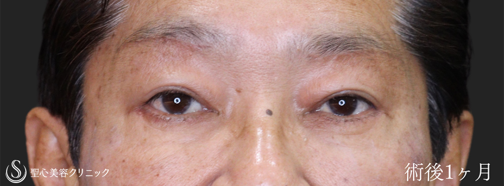 【60代男性・目の上下をスッキリ】下眼瞼切開術/下眼瞼除皺術/ハムラ法＋眉下切開法（眉下リフト）（術後1ヶ月） After 