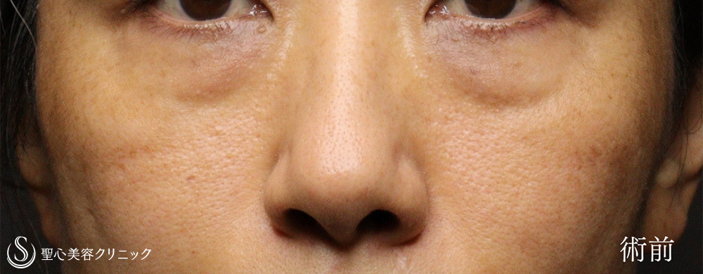 【40代女性・ハムラ法で目の下のクマを劇的に改善】下眼瞼切開術/下眼瞼除皺術/ハムラ法（術後1ヶ月） Before 
