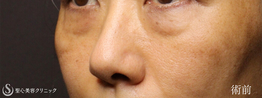 【40代女性・ハムラ法で目の下のクマを劇的に改善】下眼瞼切開術/下眼瞼除皺術/ハムラ法（術後1ヶ月） Before 